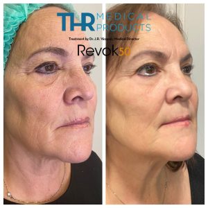 THR-Revok50-Facial-treatment