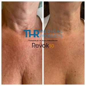 THR-Revok50-cleavage