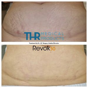 THR-Revok50-stretch-marks